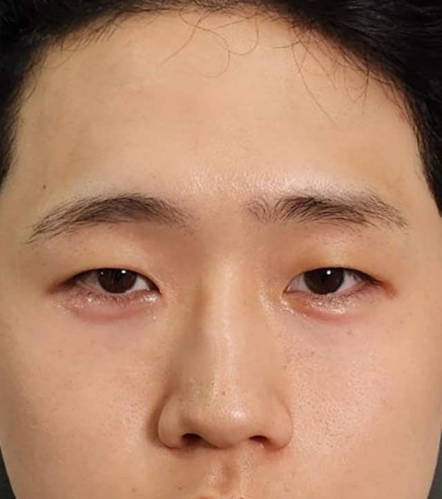 시술 후