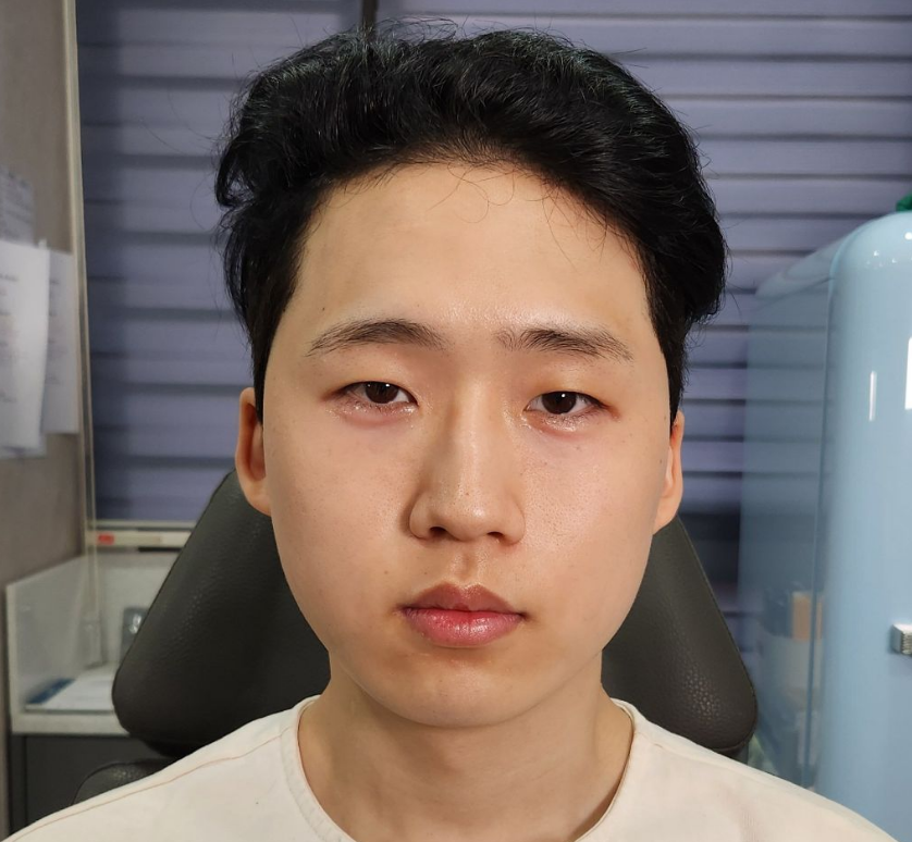 시술 후