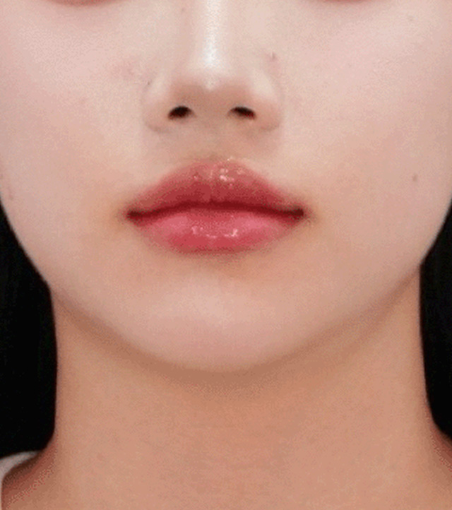 시술 후
