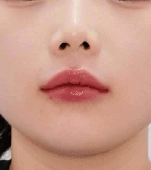 시술 후