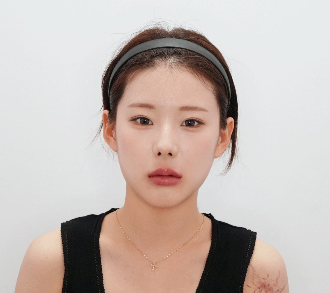 시술 후